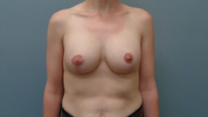 Breast Augmentation with Lift Before & After Pictures in Nashville, TN
