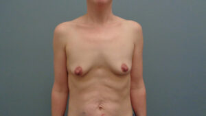 Breast Augmentation with Lift Before & After Pictures in Nashville, TN