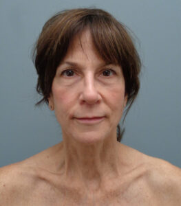 Rhinoplasty Before & After Pictures Nashville, TN