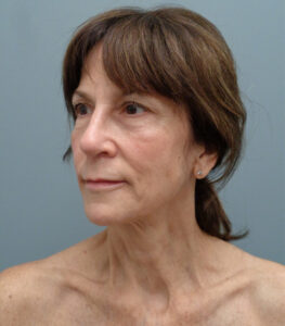Rhinoplasty Before & After Pictures Nashville, TN