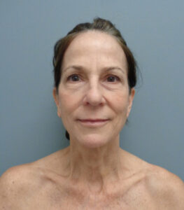 Rhinoplasty Before & After Pictures Nashville, TN