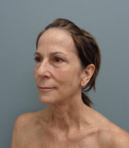 Rhinoplasty Before & After Pictures Nashville, TN