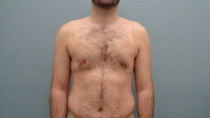 Gynecomastia Before & After Pictures Nashville, TN