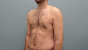 Gynecomastia Before & After Pictures Nashville, TN