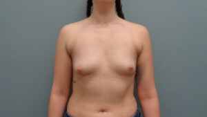 Breast Augmentation Before & After Pictures in Nashville, TN