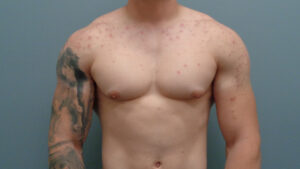 Gynecomastia Before & After Pictures in Nashville, TN