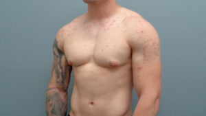 Gynecomastia Before & After Pictures in Nashville, TN