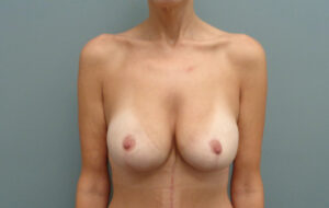 Breast Augmentation with Lift Before & After Pictures in Nashville, TN