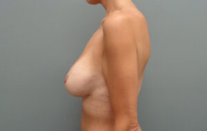 Breast Augmentation with Lift Before & After Pictures in Nashville, TN