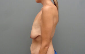 Breast Augmentation with Lift Before & After Pictures in Nashville, TN