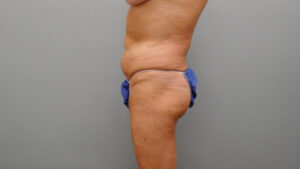 Tummy Tuck Before and After Pictures Nashville, TN