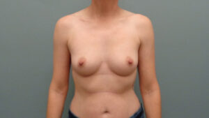 Breast Augmentation Before & After Pictures in Nashville, TN
