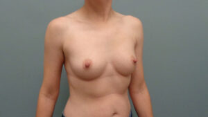 Breast Augmentation Before & After Pictures in Nashville, TN