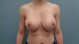 Breast Augmentation Before & After Pictures in Nashville, TN
