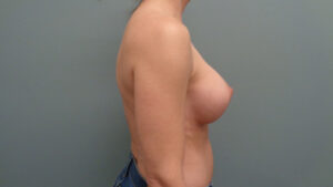 Breast Augmentation Before & After Pictures in Nashville, TN