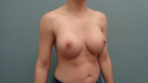 Breast Augmentation Before & After Pictures in Nashville, TN