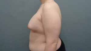 Breast Augmentation Before & After Pictures in Nashville, TN