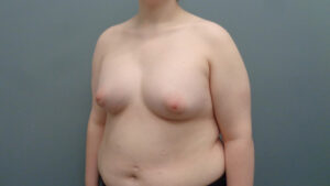 Breast Augmentation Before & After Pictures in Nashville, TN