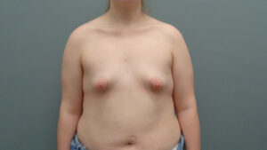 Breast Augmentation Before & After Pictures in Nashville, TN
