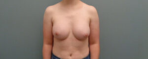Breast Augmentation Before & After Pictures in Nashville, TN