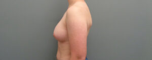 Breast Augmentation Before & After Pictures in Nashville, TN