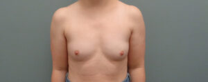 Breast Augmentation Before & After Pictures in Nashville, TN
