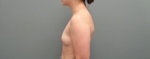 Breast Augmentation Before & After Pictures in Nashville, TN
