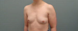 Breast Augmentation Before & After Pictures in Nashville, TN