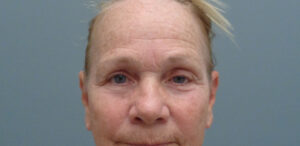 Brow Lift Before & After Pictures in Nashville, TN
