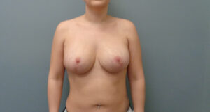 Breast Augmentation with Lift Before and After Pictures Nashville, TN