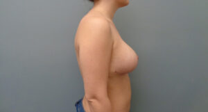 Breast Augmentation with Lift Before and After Pictures Nashville, TN
