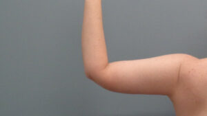 Arm Lift Before & After Pictures Nashville, TN