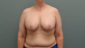 Breast Augmentation with Lift Before & After Pictures in Nashville, TN
