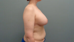 Breast Augmentation with Lift Before & After Pictures in Nashville, TN