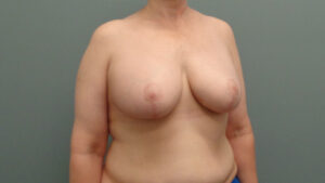 Breast Augmentation with Lift Before & After Pictures in Nashville, TN