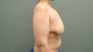 Breast Augmentation with Lift Before & After Pictures in Nashville, TN