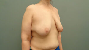 Breast Augmentation with Lift Before & After Pictures in Nashville, TN