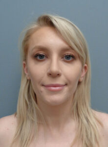 Rhinoplasty Before & After Pictures Nashville, TN