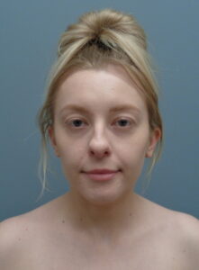 Rhinoplasty Before & After Pictures Nashville, TN