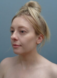 Rhinoplasty Before & After Pictures Nashville, TN