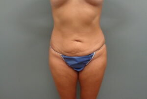 Before & After Pictures in Nashville, TN