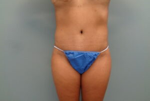 Before & After Pictures in Nashville, TN