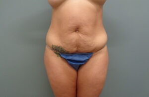 Before & After Pictures in Nashville, TN