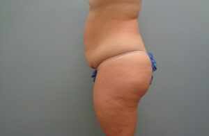 Before & After Pictures in Nashville, TN