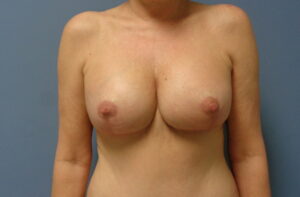 Before & After Pictures in Nashville, TN
