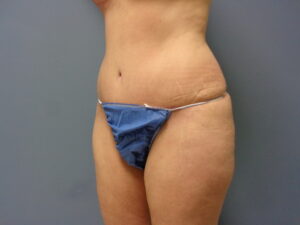 Before & After Pictures in Nashville, TN