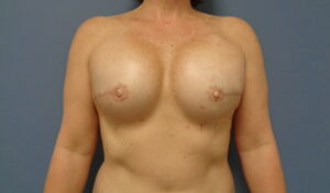 Before & After Pictures in Nashville, TN