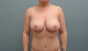 Before & After Pictures in Nashville, TN