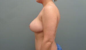 Before & After Pictures in Nashville, TN