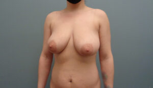 Before & After Pictures in Nashville, TN